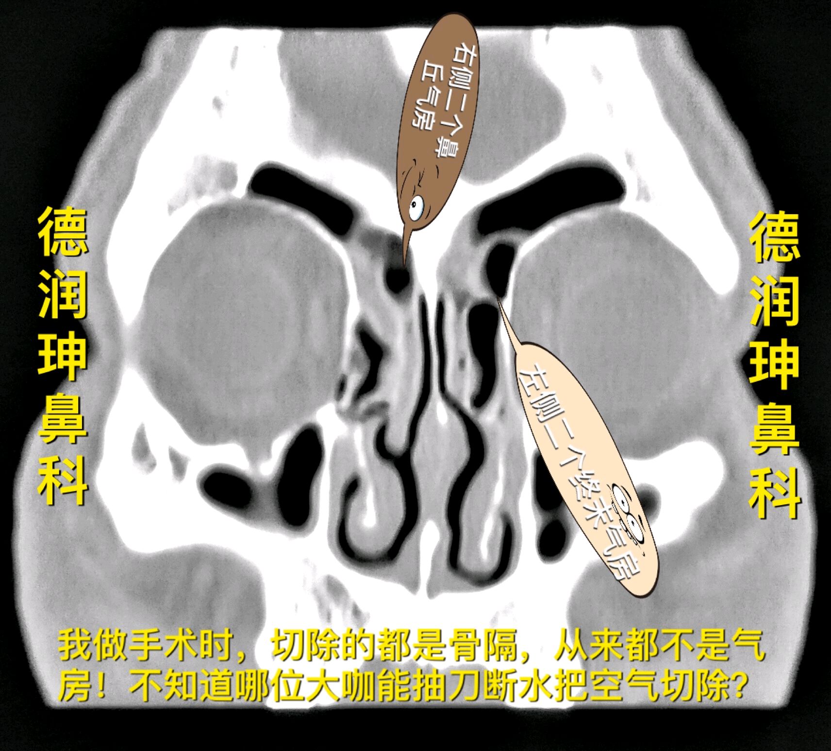 把额隐窝区域内的分割的气房弄得越复杂,越让手术医生无所适从,对安全