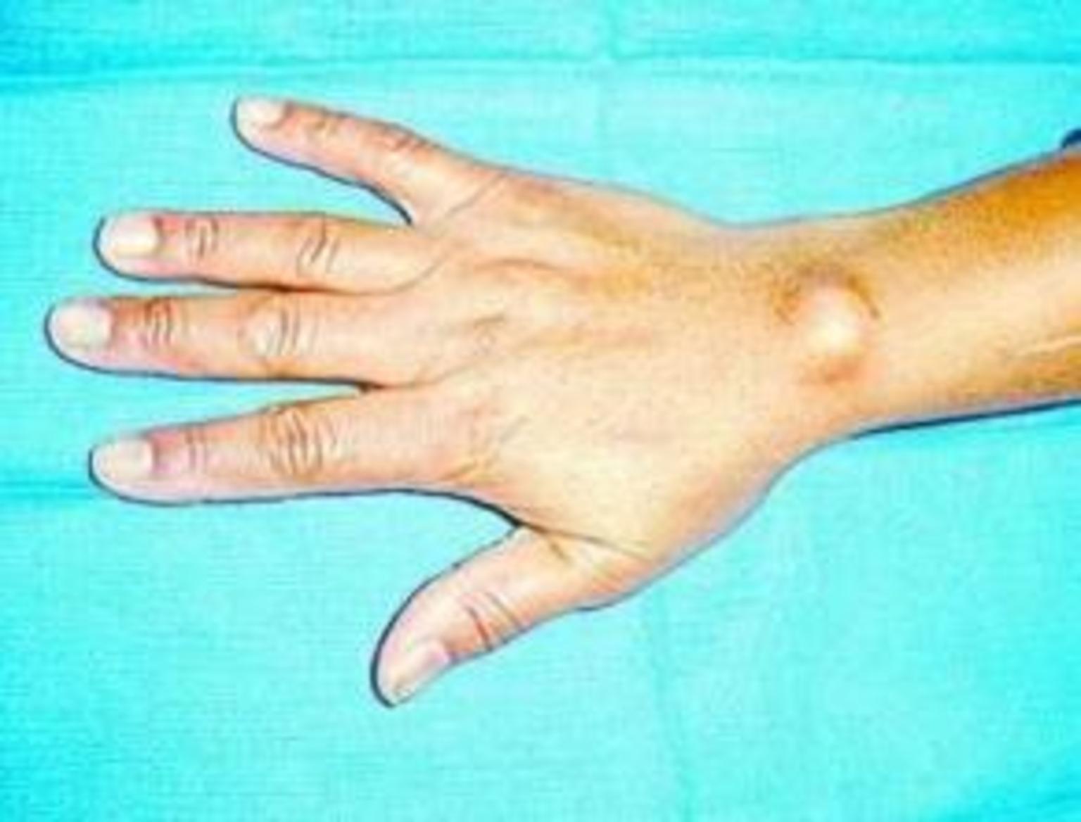 【简单按摩】掌指（拇指）关节腱鞘炎治疗手法来了_哔哩哔哩_bilibili