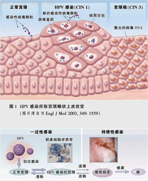 得了宫颈癌吃什么 - 华夏肿瘤康复网
