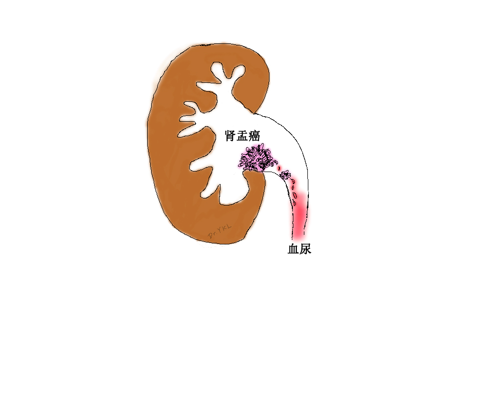老年人无痛性血尿,需警惕尿路上皮肿瘤可能