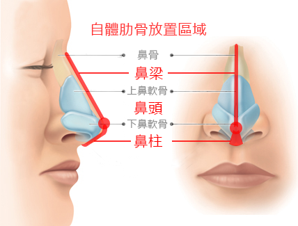 肋软骨隆鼻示意图图片