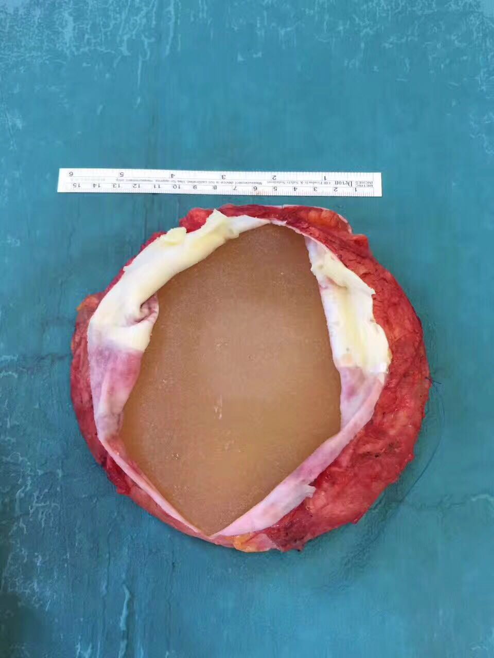 我们可以清晰的看到已经变黄的硅胶假体,外面的这层就是人体排异假体
