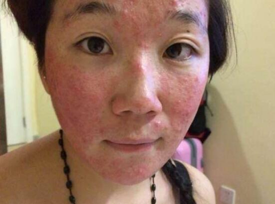 怎么远离激素脸