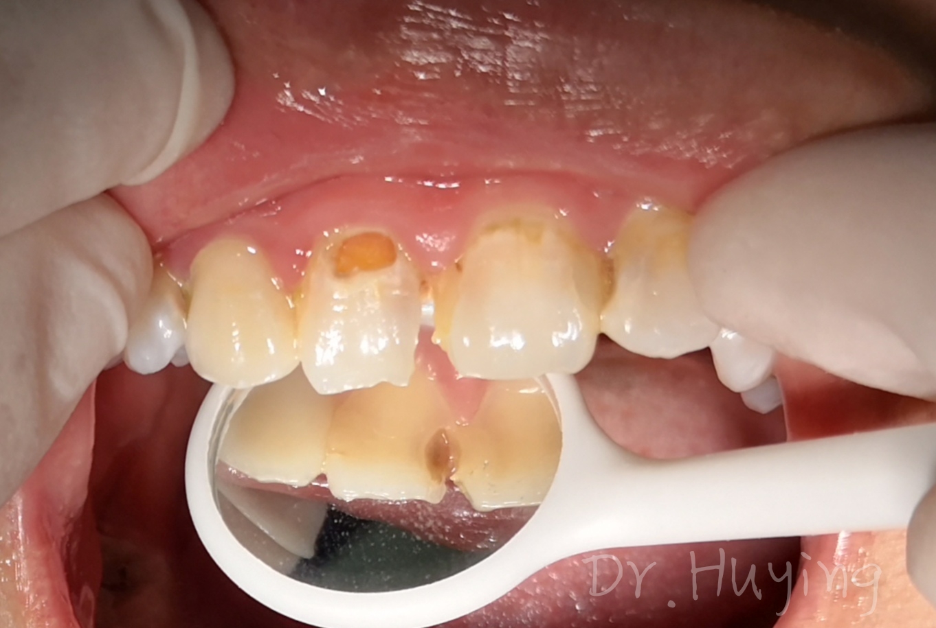 氟化物防龋原理: 氟参与牙体组织生成氟磷灰石,形成的牙釉质较坚硬,有