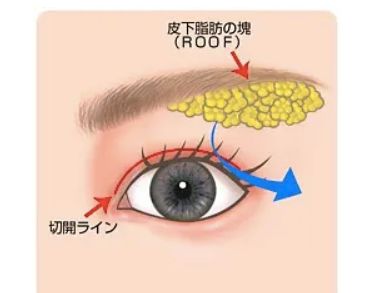 什么是roof脂肪为什么要去除