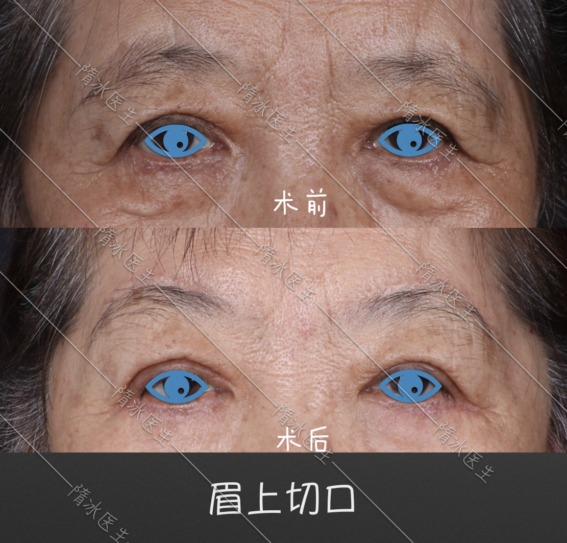 上睑松垂矫正 如何根据面部条件选切口 Dino 新浪博客