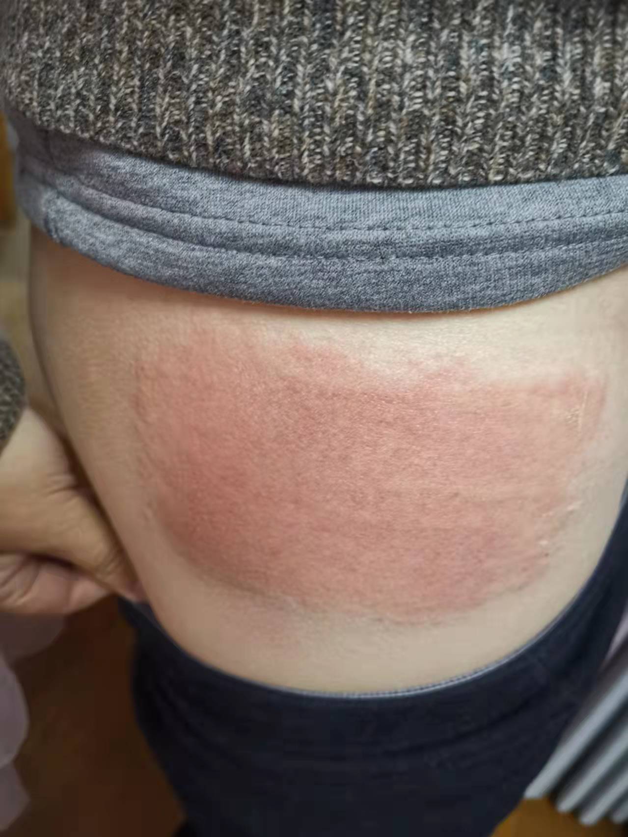 皮肤发炎用百多邦