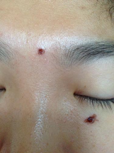 点痣为什么会留下疤痕?,_刘守卫__爱问健康