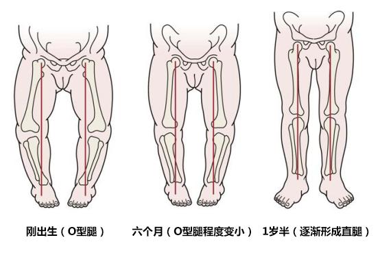 小孩8歲還是x型腿該如何有效糾正