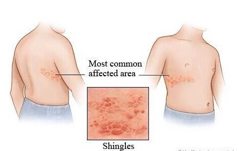 帶狀皰疹:是多大個事?