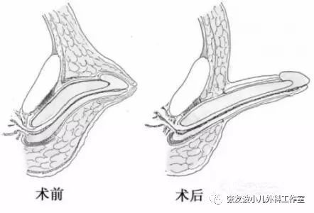害羞的小蜗牛男孩外生殖器疾病之隐匿性阴茎