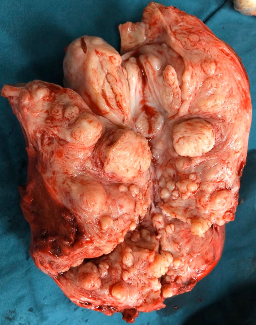 子宫肌瘤图片真实图片图片