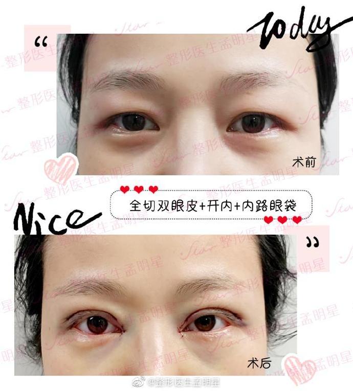 很多求美者做完眼袋手术 眼周容易发黄和淤青 是手术失败了吗 整形医生孟明星 新浪博客