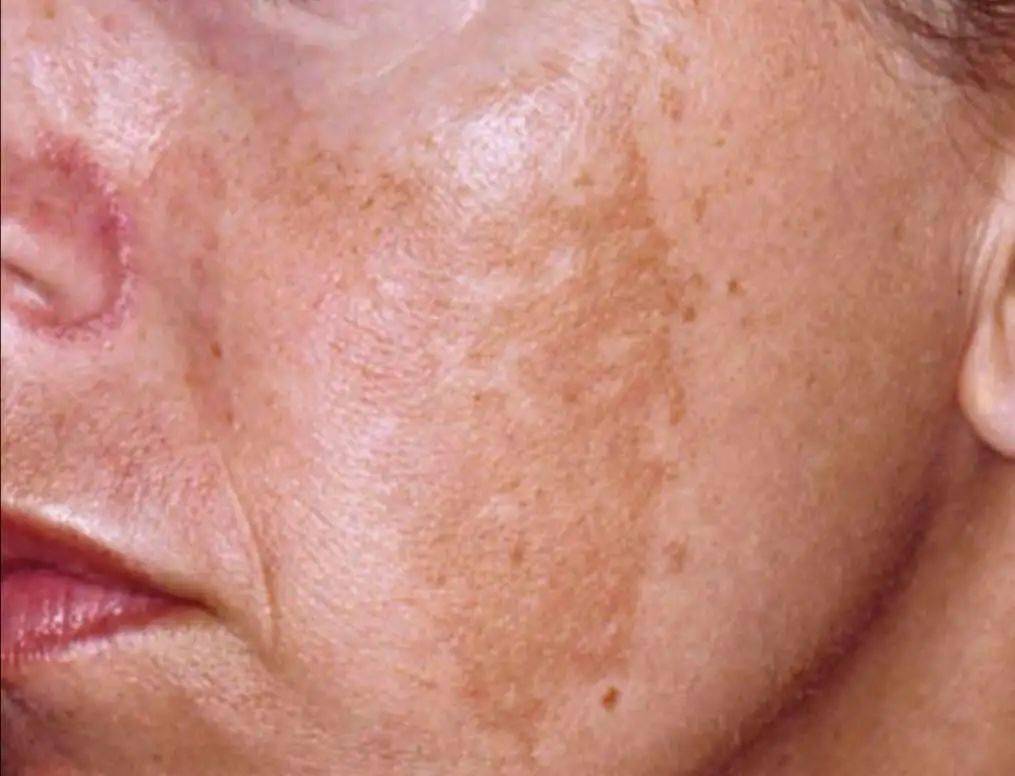 脸上长斑人变丑中药面膜祛色斑