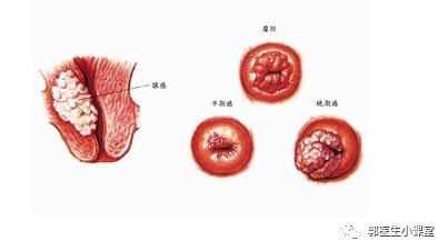 女性下面长肉芽的原因图片