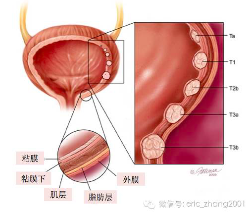 膀胱里长了东东?