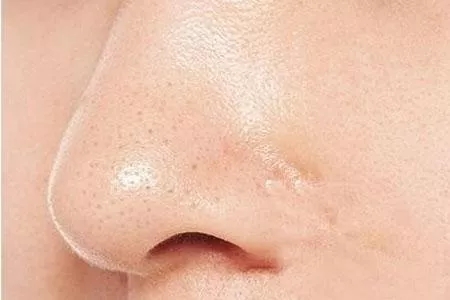 你以为的黑头可能是脂质微丝!