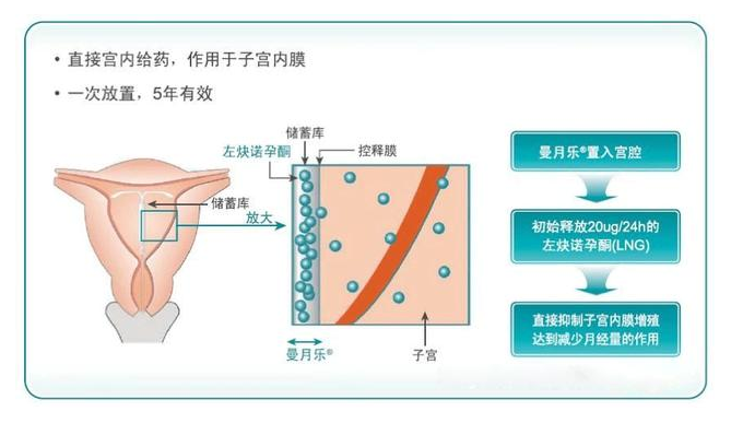 曼月樂治療子宮腺肌症,醫學上陰差陽錯的發明