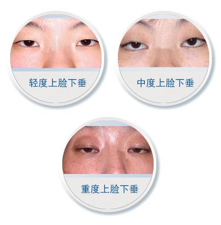 "上睑下垂矫正 切开双眼皮"真人案例展示