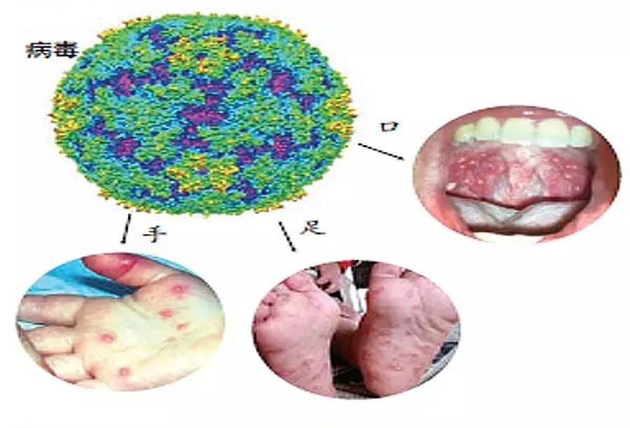 手足口進入流行期家長要漲這些知識