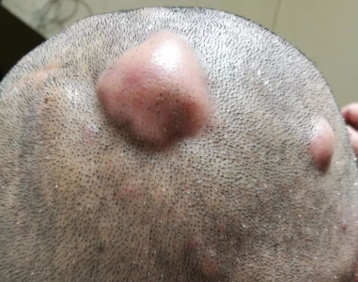 令人抓狂的头部毛囊周围炎