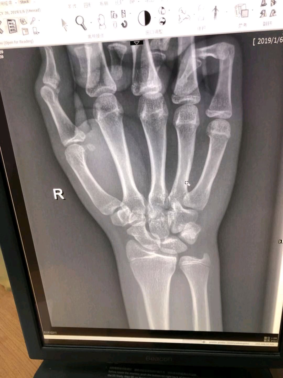 骨科张医生  我儿子手腕扭伤了 帮忙看一下 手腕旋转疼可以先支具