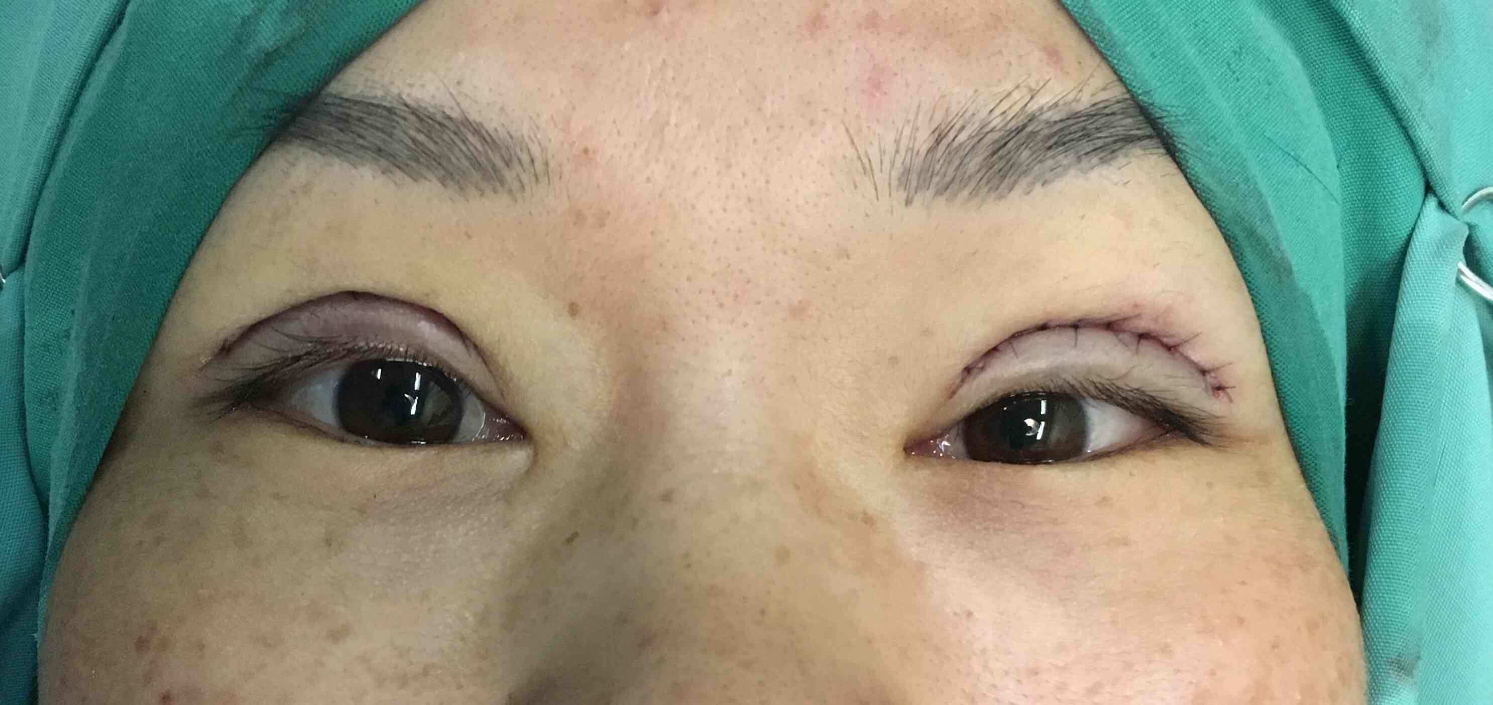 埋线双眼皮是微创手术也不尽然.