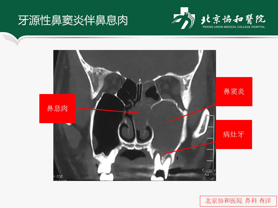 牙源性鼻竇炎如何治療