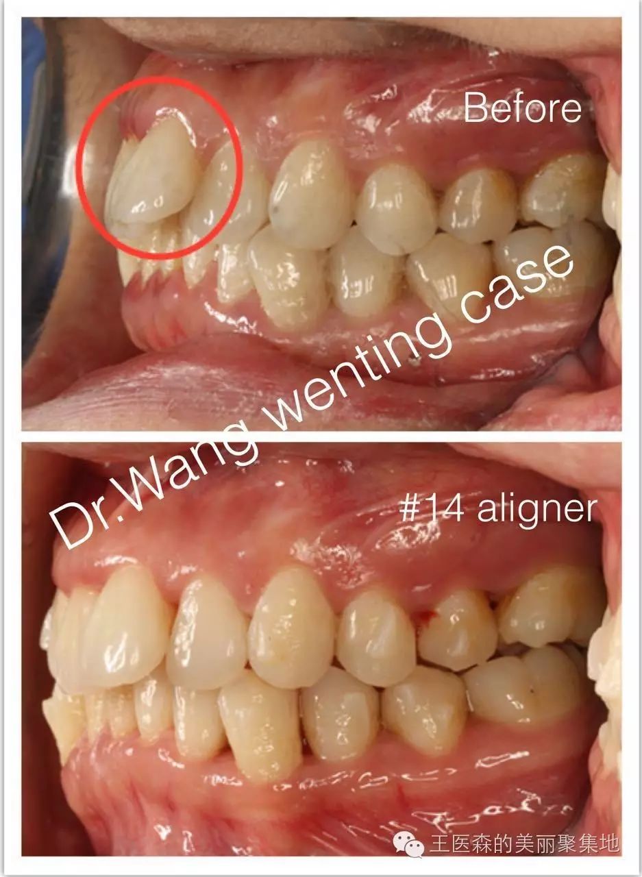 可以看一下,这颗最明显的翘在牙列外面的牙齿也回去了不少