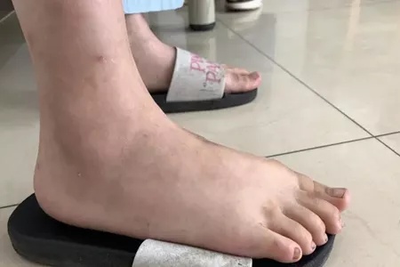 10岁女童膝盖肿胀如"馒头",竟是幼年特发性关节炎!