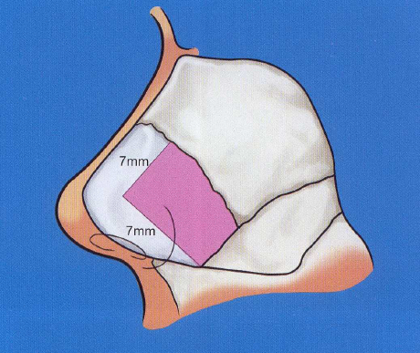 肋軟骨與鼻中隔軟骨在鼻整形應用中的利與弊