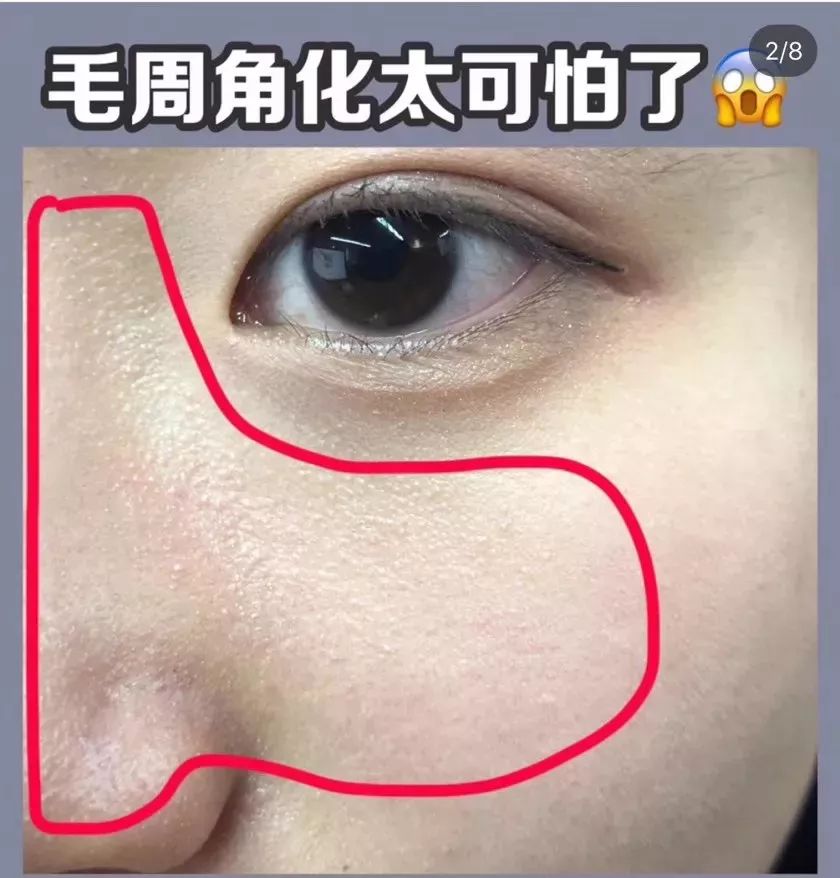 闭口怎么去鸡皮肤色素(闭口怎么去鸡皮肤色素痣)