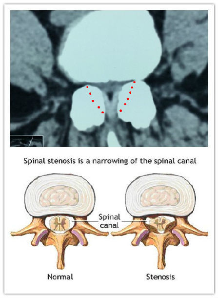 图1,腰椎正侧位提示腰椎退行性变,腰椎核磁共振提示l4-5椎管狭窄,红色