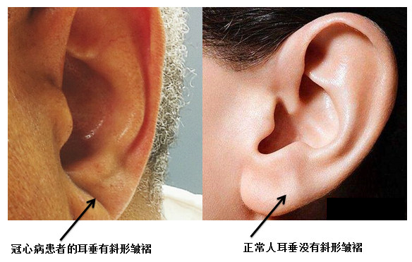 看耳朵也能看出有没有冠心病,迷信还是科学?