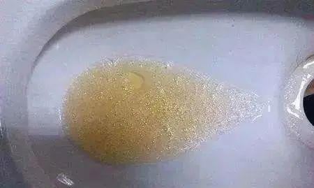 一文洞悉泡沫尿是怎么回事