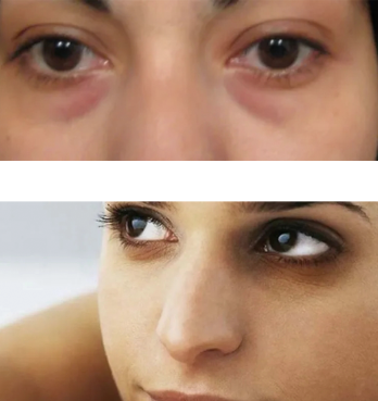 黑眼圈克星来喽~真的真的很管用!