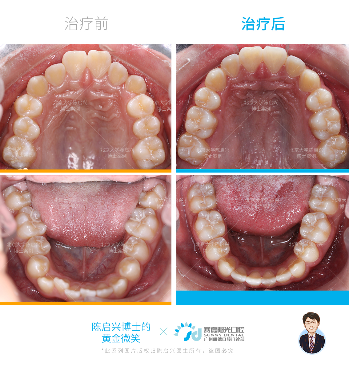 经过了解发现,他是有过敏性鼻炎的,并且由于腺样体肥大,导致口呼吸,长