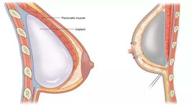 3,隆胸假体移位游走03这种情况往往发生在做腋下切口的病人.