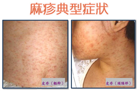 其他边发热边出皮疹的病就很多啦,一定要带去看医生来确诊:比如麻疹