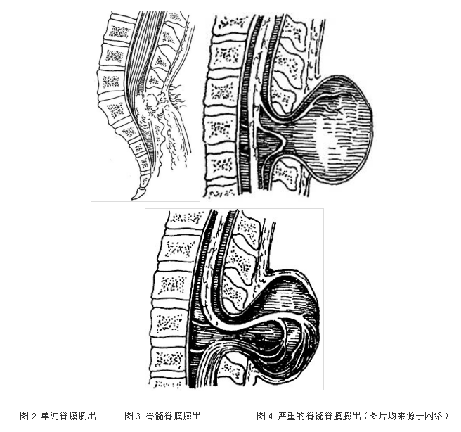脊柱裂脊膜膨出图片图片