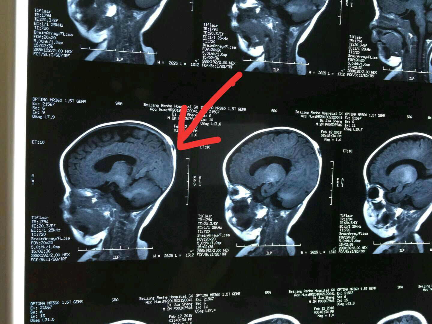 脑膜脑膨出图片图片