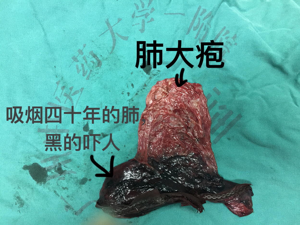 长期吸烟病人的黑肺及肺大疱