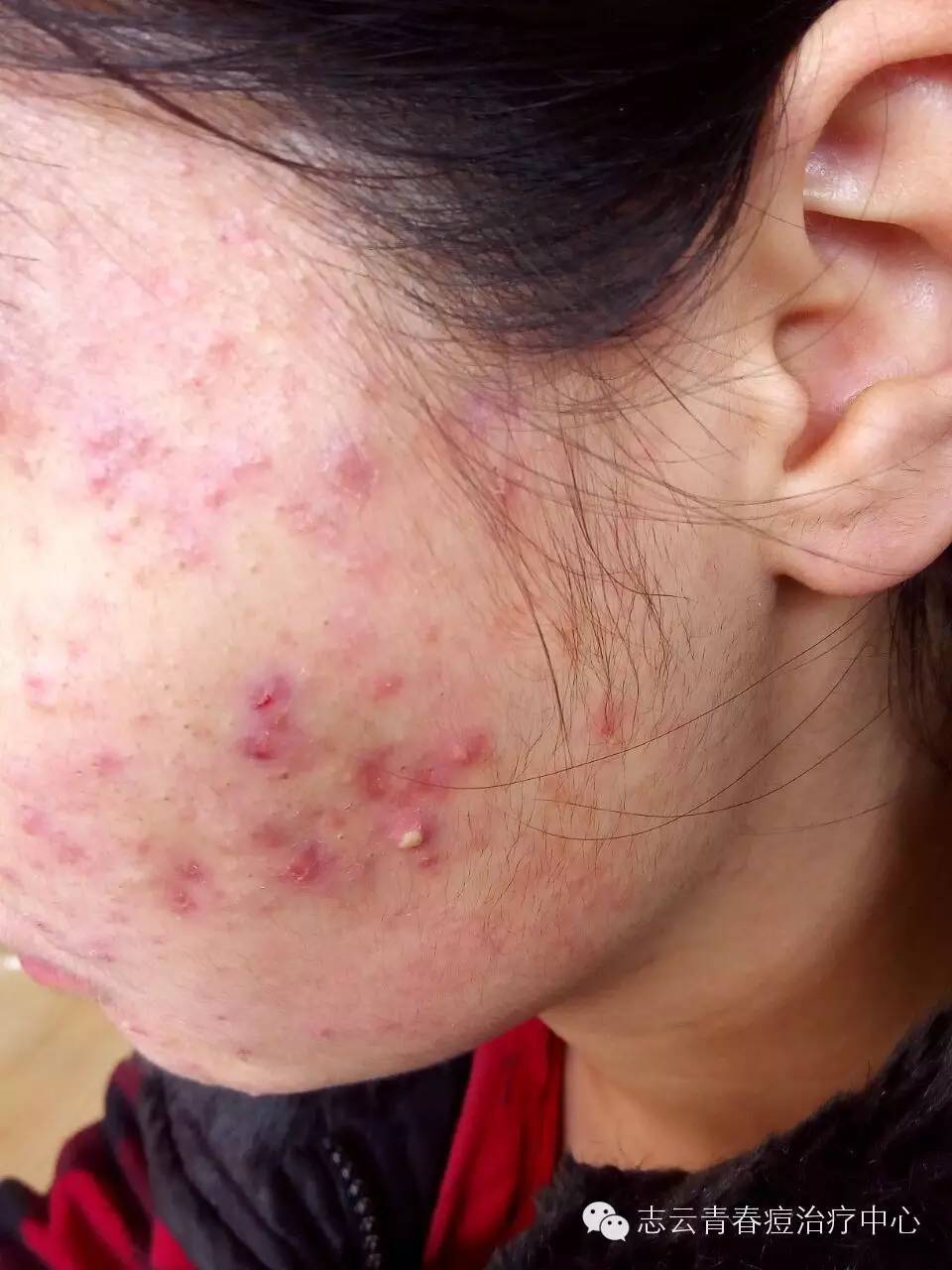 什么样的痘痘不可以挤?