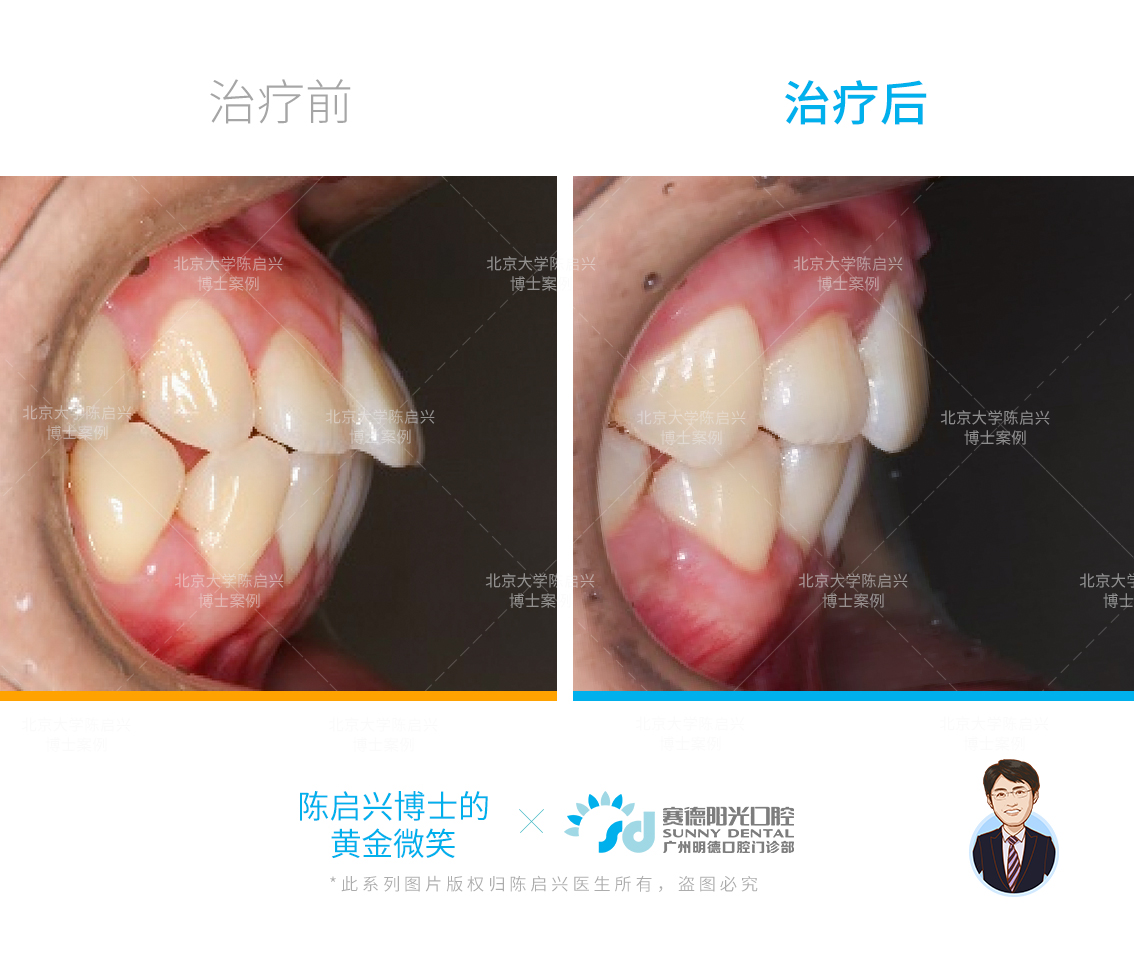 骨性双颌前突图片图片