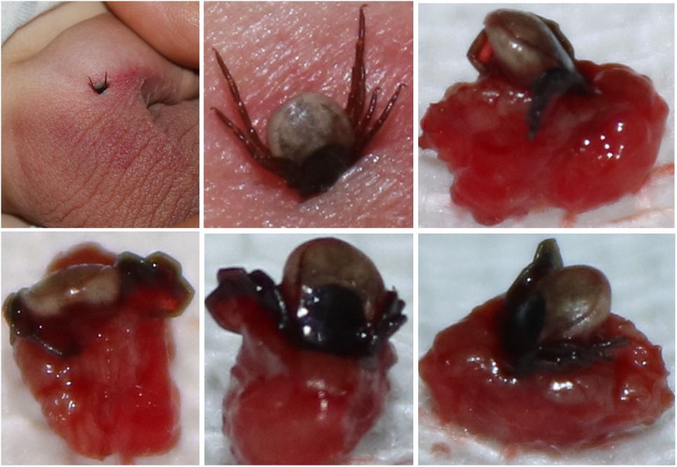 蜱虫钻进皮肤里,该不该用烟头烫?