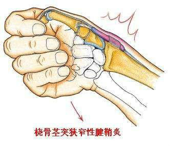 腱鞘炎和腱鞘囊腫是一回事嗎?