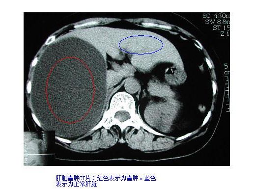 體檢發現肝囊腫,勿驚慌