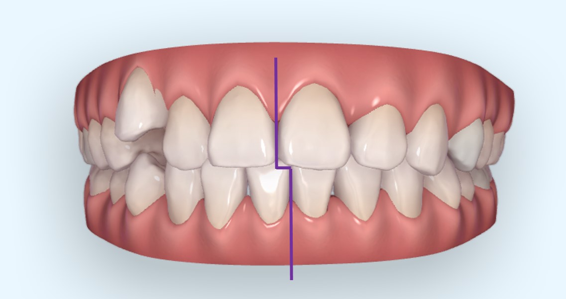 错位,导致了上牙弓的不对称,切牙都向右移位,上中线向右侧偏斜,上下牙