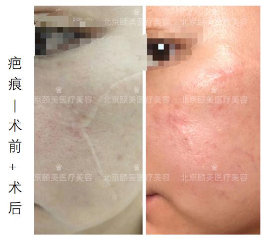 白色疤痕有办法去除吗