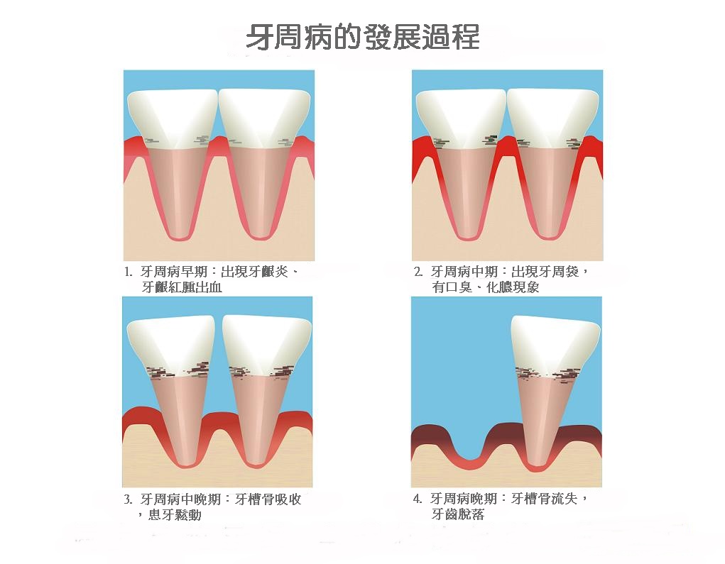 最好還是先對牙周病進行治療